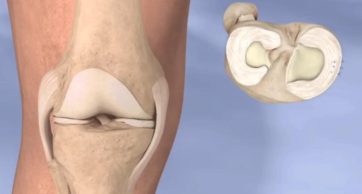 Moda İnşaat Menüsküs Yırtığı