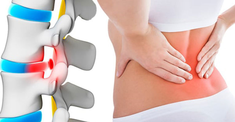 Moda İnşaat Bel Fıtığı